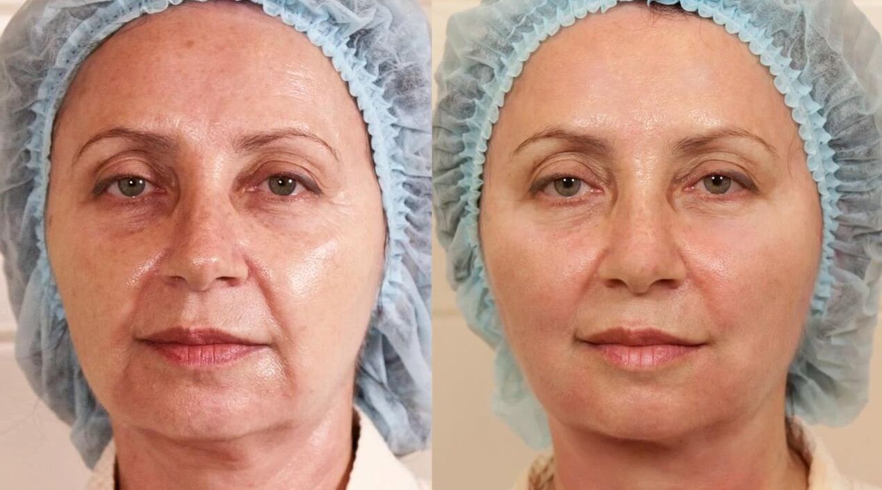 Before and after face lift photos