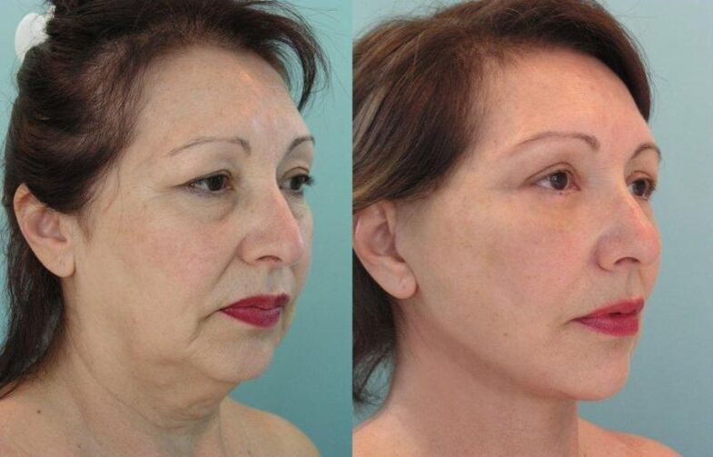 The result of tightening the facial skin with rejuvenating threads