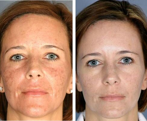 Before and after facial fractional thermolysis