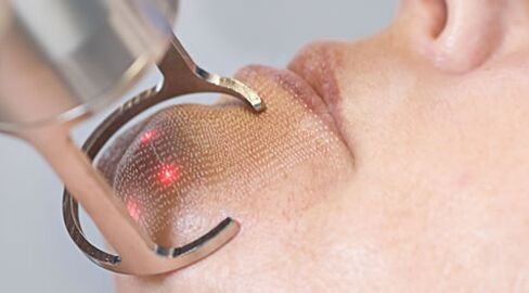Course of the procedure for laser skin rejuvenation