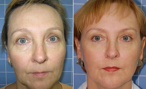 Facial and facial fractional laser rejuvenation