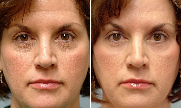 Facial laser fractional rejuvenation before and after